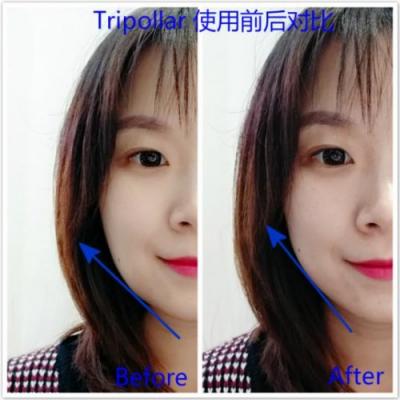 雅萌、GEVILAN歌嵐、Tripollar、NEWA美容儀到底選哪個(gè)？先評(píng)測(cè)一下再說(shuō)